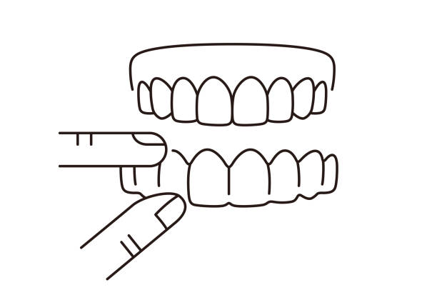 Clear Aligners